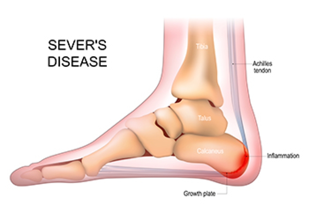 Sever’s Disease in Active Children