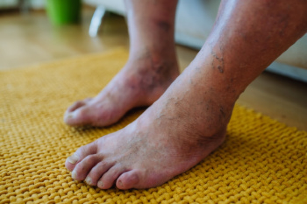 Diabetes and Protecting Your Feet