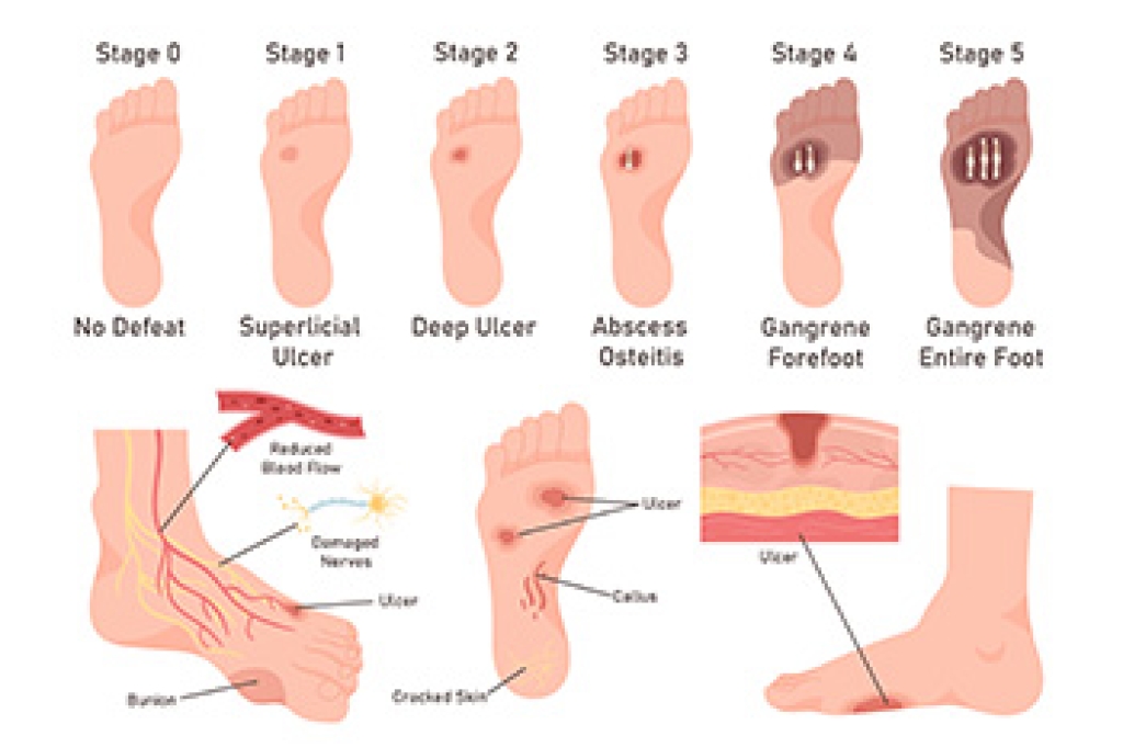 How Everyday Injuries Can Lead to Diabetic Foot Ulcers