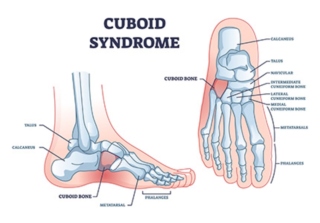 Cuboid Syndrome and Lateral Midfoot Pain