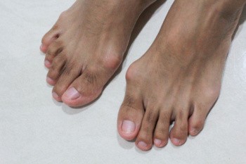 Living With Bunions