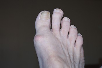 Morton’s Toe Can Lead To Ongoing Foot Pain
