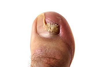Thick Toenails and Toenail Fungus
