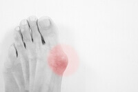 Athlete&#039;s Foot