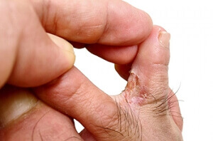 Why Do I Have Plantar Fasciitis?