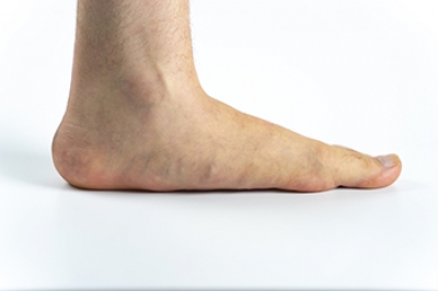 Is There a Difference Between Flat Feet and Overpronation?