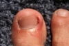 Three Grades of Ankle Sprains